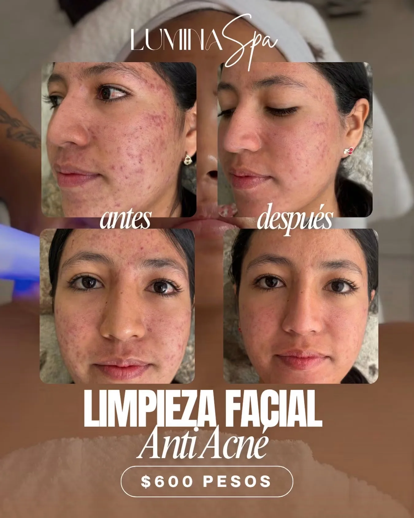 Resultado antes y después de limpieza facial anti acné